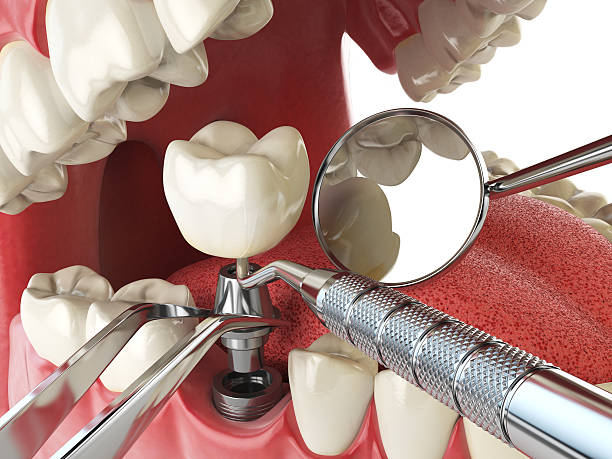 Best Emergency Treatment for Toothache in Simmesport, LA